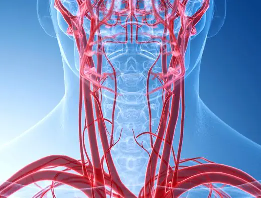 Carotid Artery Disease