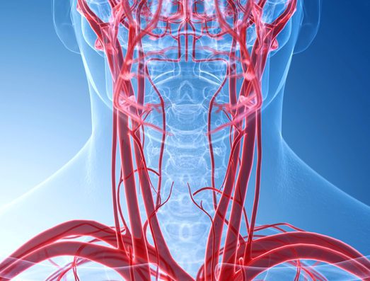 Carotid Artery Disease